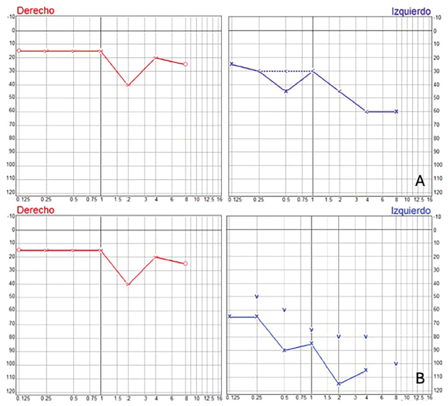 Figura 1. Audiometría tonal al diagnóstico (A) y a las 48 horas (B)